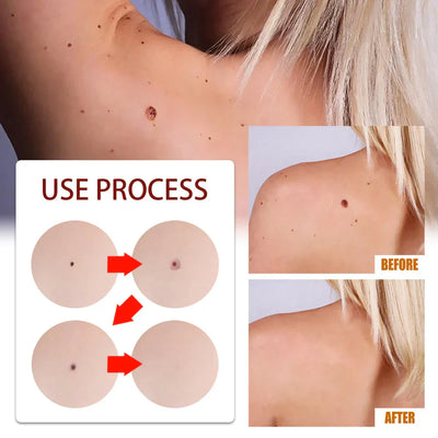 Candice™ - Formula for Removing Dark Spots (Buy 1 Get 1 Free!)