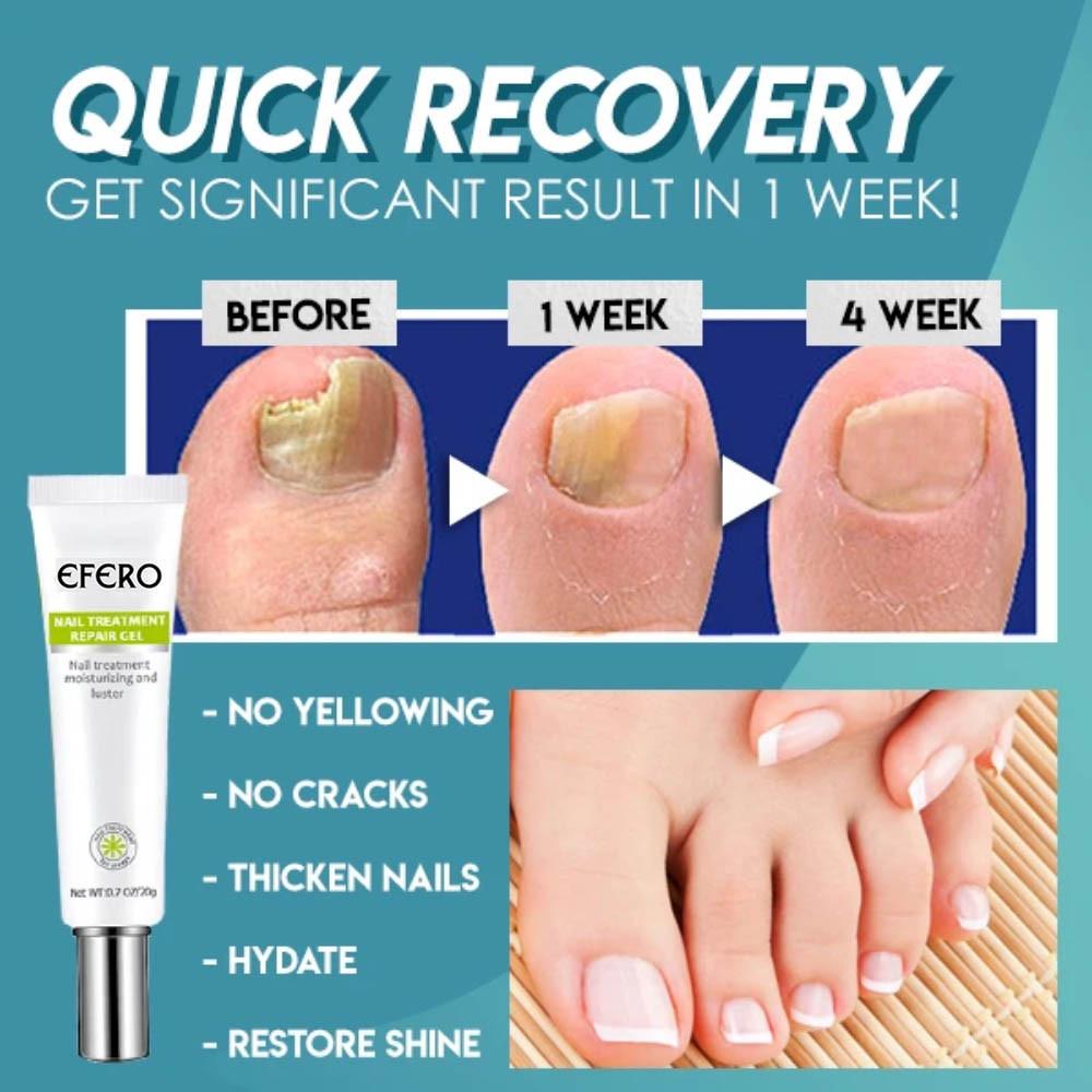 Nail Repair | Fast and Effective Results! 1+1 FREE!